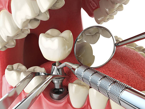 Best Emergency Denture Repair in Keedysville, MD